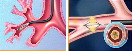 bronchial-thermoplasty