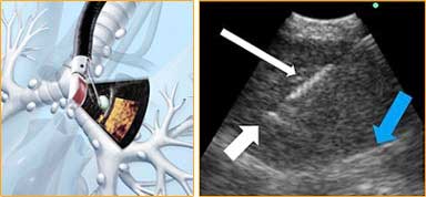 procedures Ultrasound Bronchoscopy